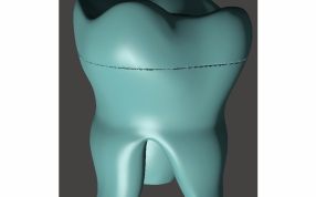 牙模盒子模型效果图